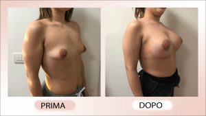 prima e dopo mastoplastica additiva mammelle tuberose Dottore Chirurgo Cristiano Biagi
