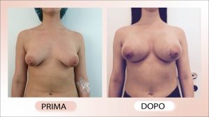 prima e dopo mastoplastica additiva mammelle tuberose Dottore Chirurgo Cristiano Biagi 21