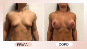 prima e dopo mastoplastica additiva mammelle tuberose Dottore Chirurgo Cristiano Biagi