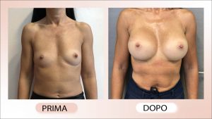 prima e dopo mastoplastica additiva asimmetrie mammarie