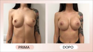 prima e dopo mastoplastica additiva asimmetrie mammarie 12