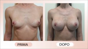 prima e dopo mastoplastica additiva asimmetrie mammarie